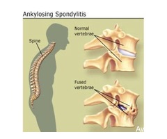 Wonderful healing for ankylosing spondylitis 