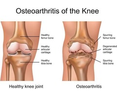 Speedy Healing From Osteoarthritis (Call or WhatsApp - 08028589079)