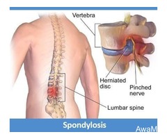 Treatment For Lumbar Spondylosis at Benign Evexia Center